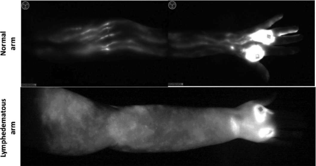 Indocyanine green (ICG) lymphangiography of a normal (upper) and lymphedematous (lower) upper extremity.