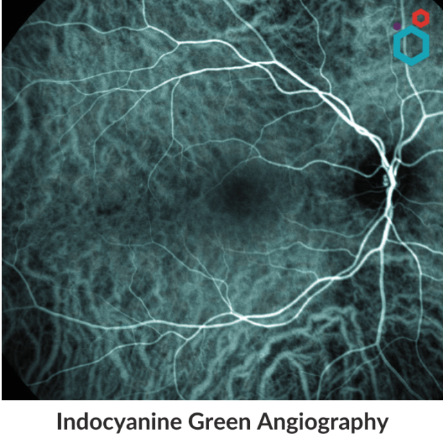 Indocyanine Green Angiography